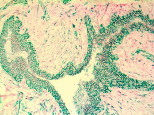 IHC of CD44 on an FFPE Breast Fibroadenoma Tissue